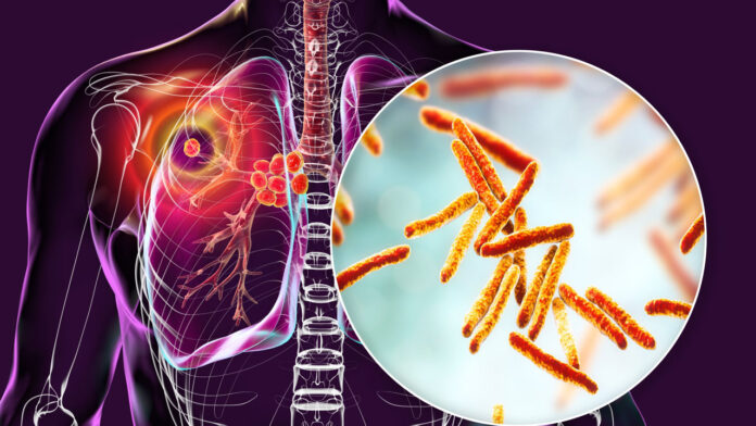 लगातार बढ़ रही टीबी मरीजों की संख्या लगातार बढ़ रही टीबी मरीजों की संख्या